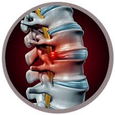 Of Spinal Discs and Jelly Donuts