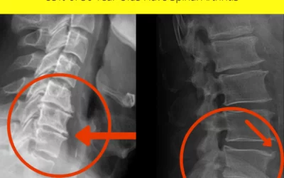 The #1 Cause Of Disability in the U.S.A. is . . .